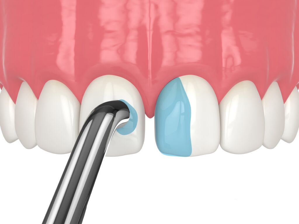 How to Choose the Best Dentist for Dental Bonding in Katy, TX