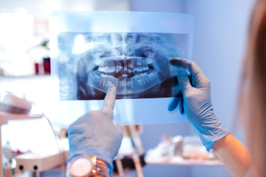 What Does Cancer Look Like on a Dental X-Ray?